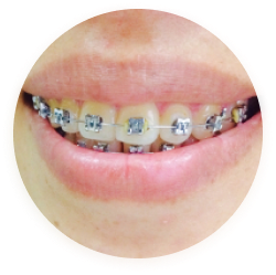 Showcase Photo For Damon Braces